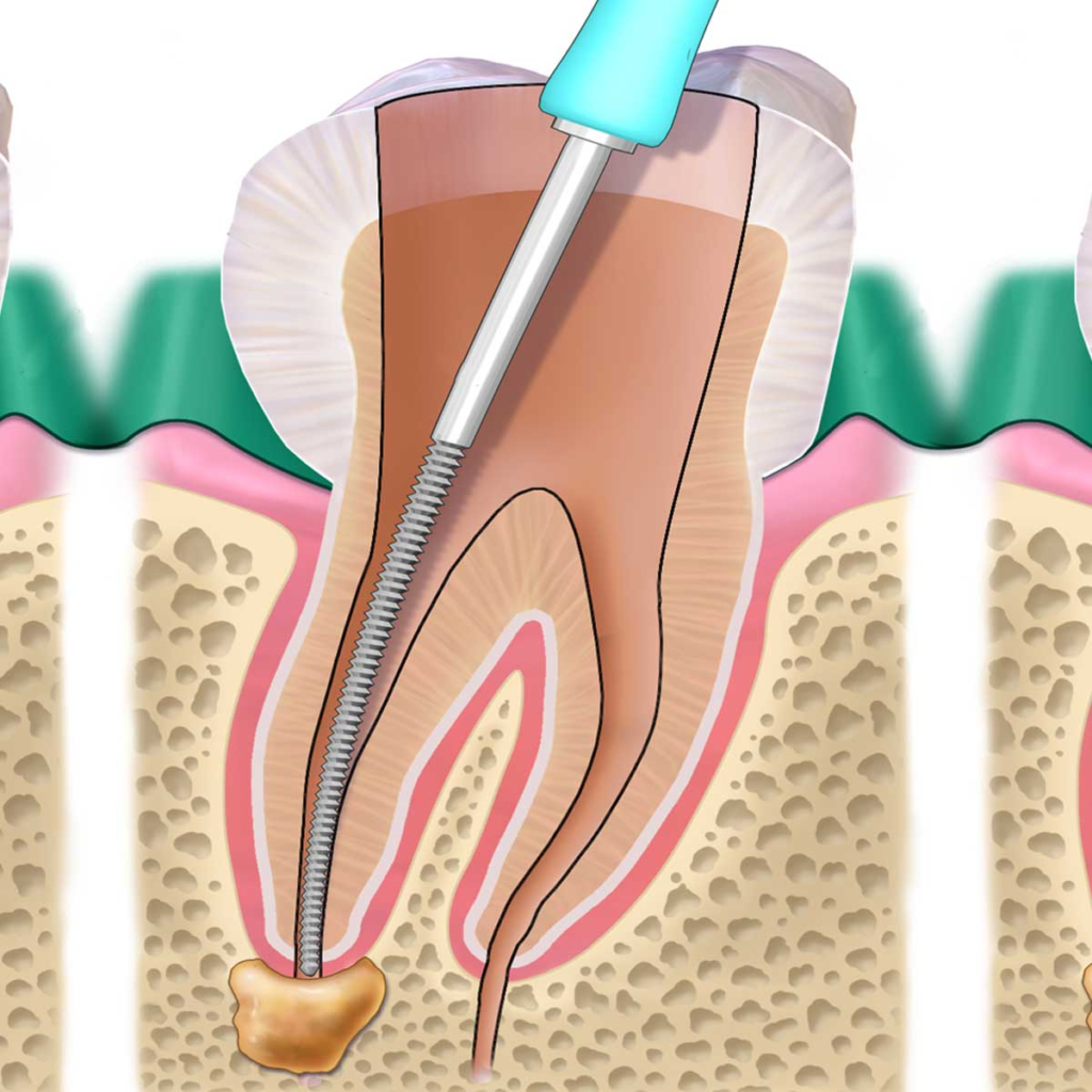 devitalizzazione dente