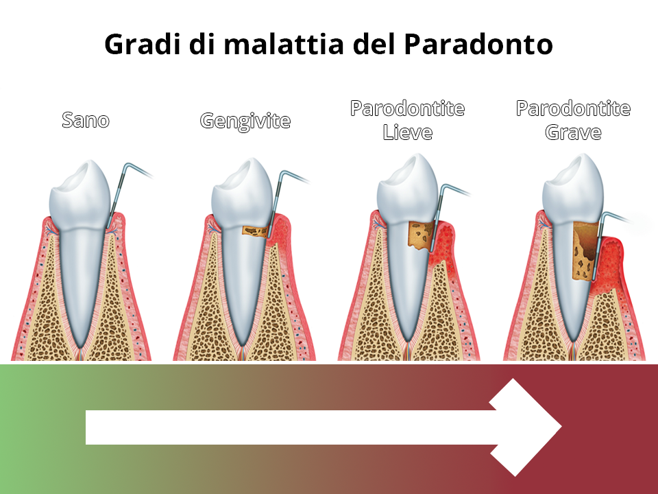cura del parodonto