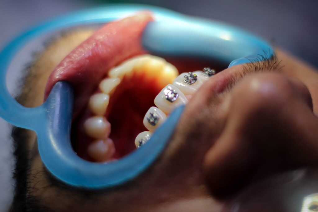 Apparecchio per denti cava manara