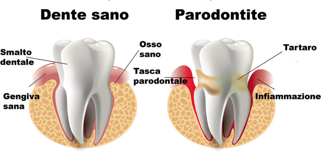 cura del parodonto
